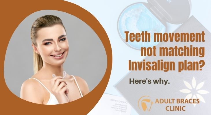 Reasons Why Your Teeth Does Not Move Following Invisalign Treatment